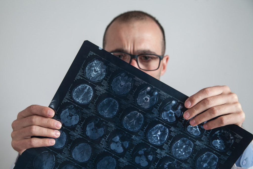 Neurological Disorders Vertigo Management BPPV Management